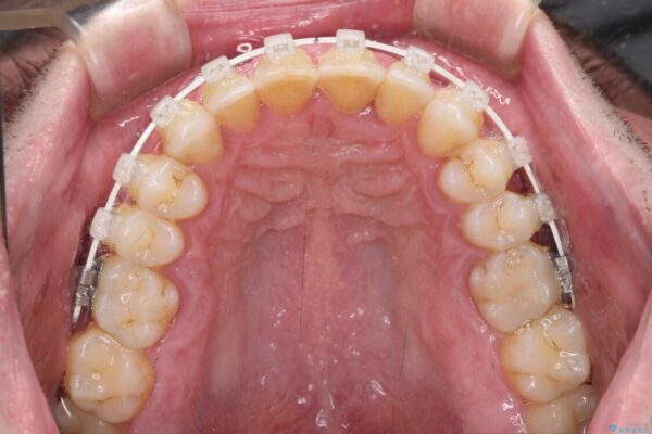 前歯でものを噛みきりたい　目立たない装置でのワイヤー矯正 治療途中画像