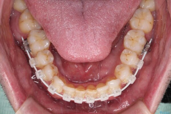 前歯でものを噛みきりたい　目立たない装置でのワイヤー矯正 治療途中画像