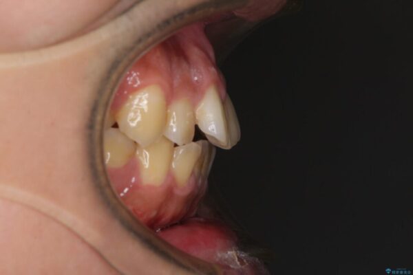 後戻りでデコボコの前歯　インビザライン矯正治療 治療前画像