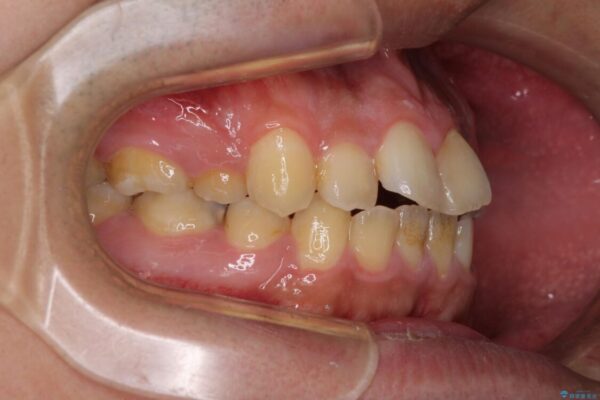 後戻りでデコボコの前歯　インビザライン矯正治療 治療前画像