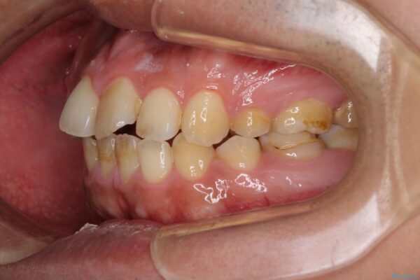 後戻りでデコボコの前歯　インビザライン矯正治療 治療前画像