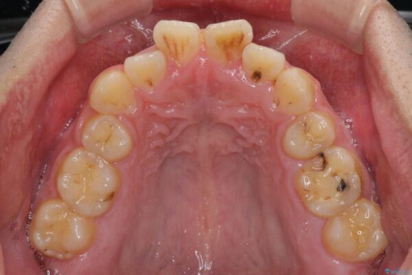 後戻りでデコボコの前歯　インビザライン矯正治療 治療前画像