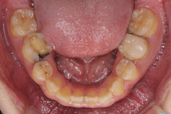 後戻りでデコボコの前歯　インビザライン矯正治療 治療前画像