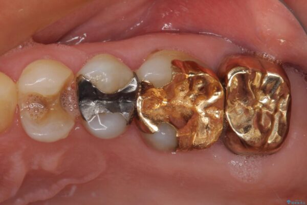 外れてしまった銀歯　セラミックインレーで自然な仕上がりに 治療前画像