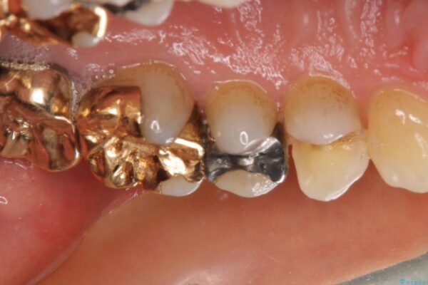 外れてしまった銀歯　セラミックインレーで自然な仕上がりに 治療前画像