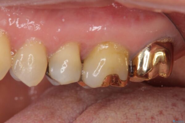 外れてしまった銀歯　セラミックインレーで自然な仕上がりに 治療前画像