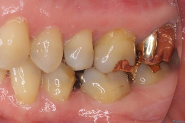 外れてしまった銀歯　セラミックインレーで自然な仕上がりに 治療前画像