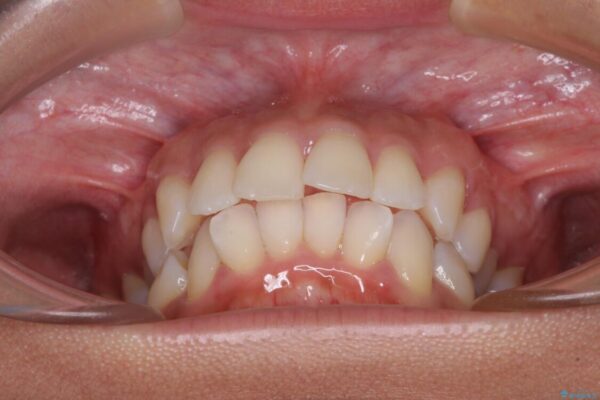 抜歯矯正で唇を閉じやすく　目立たないワイヤー装置 治療前画像