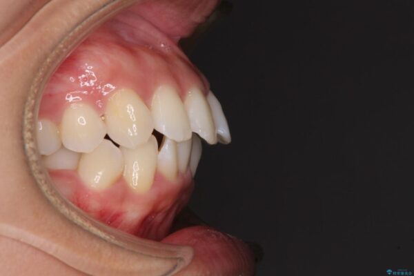 抜歯矯正で唇を閉じやすく　目立たないワイヤー装置 治療前画像