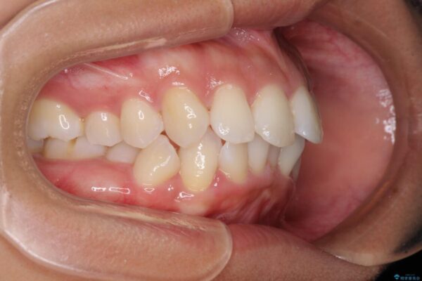 抜歯矯正で唇を閉じやすく　目立たないワイヤー装置 治療前画像