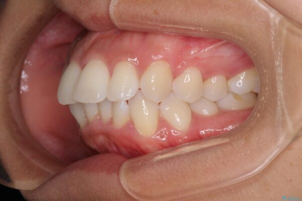 抜歯矯正で唇を閉じやすく　目立たないワイヤー装置 治療前画像