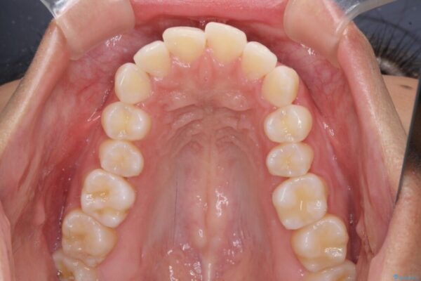 抜歯矯正で唇を閉じやすく　目立たないワイヤー装置 治療前画像
