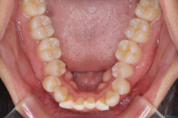 抜歯矯正で唇を閉じやすく　目立たないワイヤー装置 治療前画像