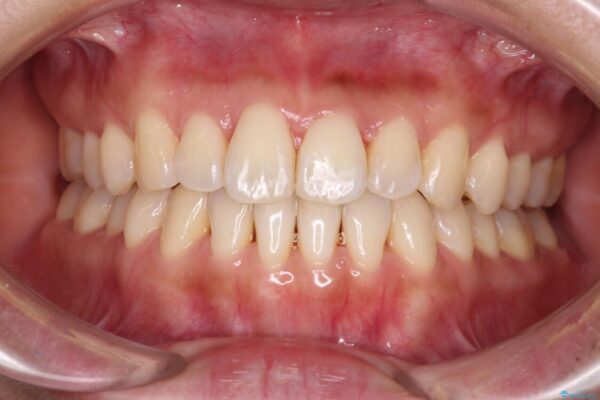 【モニター】前歯のデコボコをインビザラインで改善 治療途中画像