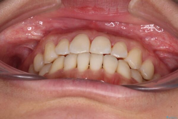 【モニター】前歯のデコボコをインビザラインで改善 治療途中画像