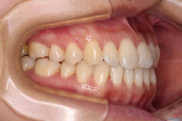 【モニター】前歯のデコボコをインビザラインで改善 治療途中画像