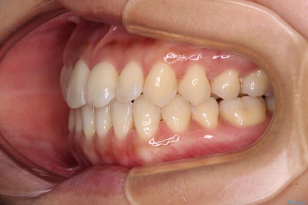 【モニター】前歯のデコボコをインビザラインで改善 治療途中画像
