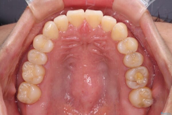 【モニター】前歯のデコボコをインビザラインで改善 治療途中画像