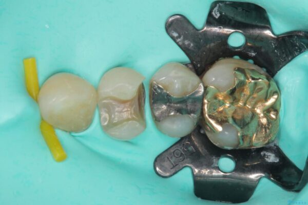 外れてしまった銀歯　セラミックインレーで自然な仕上がりに 治療途中画像