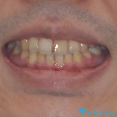 後戻りでデコボコの前歯　インビザライン矯正治療 アフター