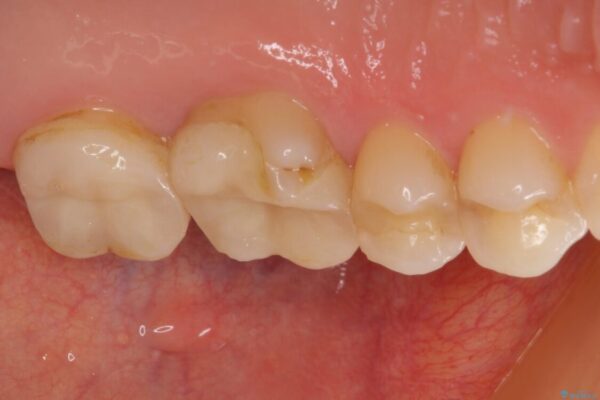 奥歯がズキズキと痛む　奥歯の虫歯治療 治療前画像