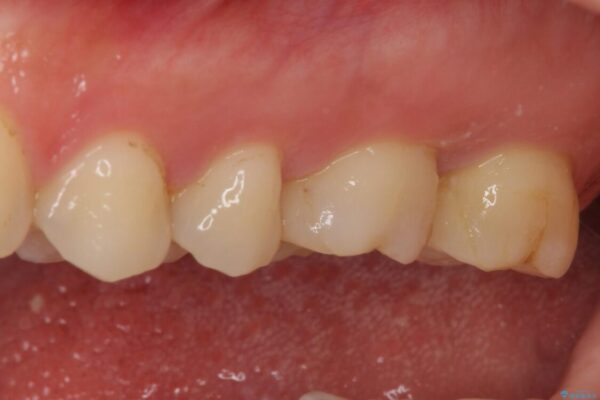 奥歯がズキズキと痛む　奥歯の虫歯治療 治療前画像