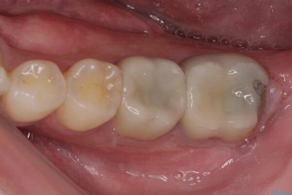 海外赴任前に治したい　割れてしまった奥歯のオールセラミッククラウン 治療前画像