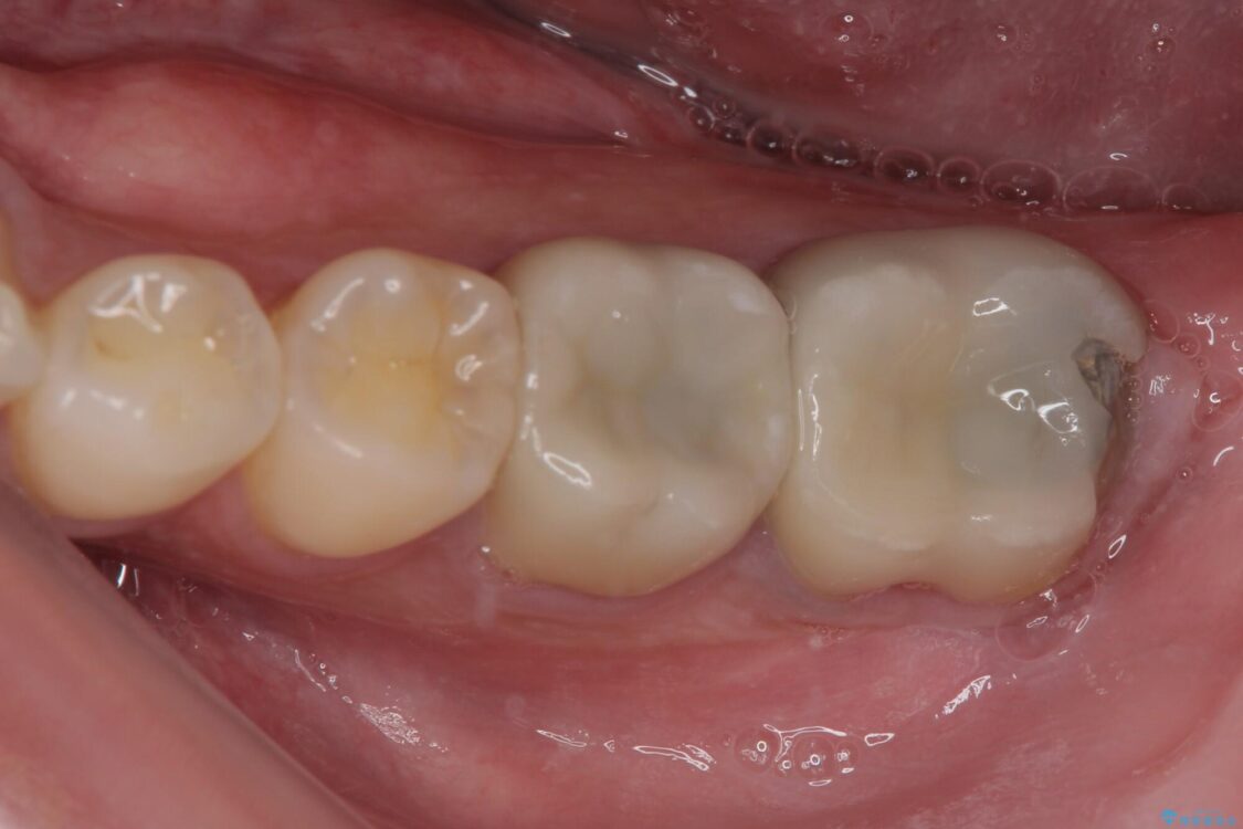 海外赴任前に治したい　割れてしまった奥歯のオールセラミッククラウン 治療前