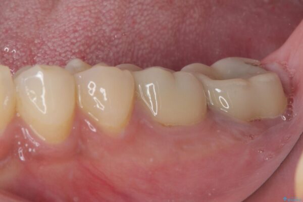 海外赴任前に治したい　割れてしまった奥歯のオールセラミッククラウン 治療前画像