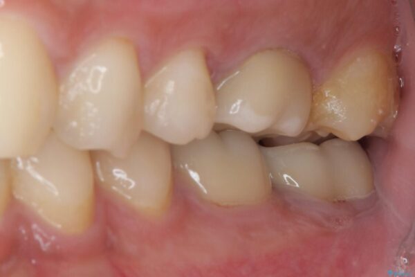 海外赴任前に治したい　割れてしまった奥歯のオールセラミッククラウン 治療前画像