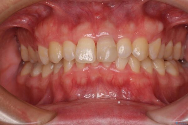 変色した前歯をオールセラミッククラウンに 治療前画像