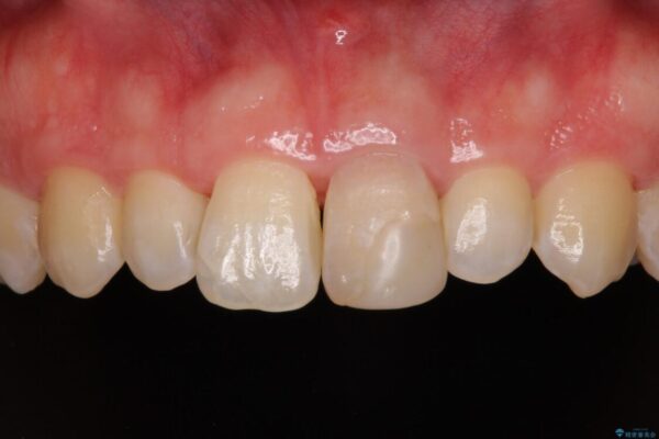変色した前歯をオールセラミッククラウンに ビフォー