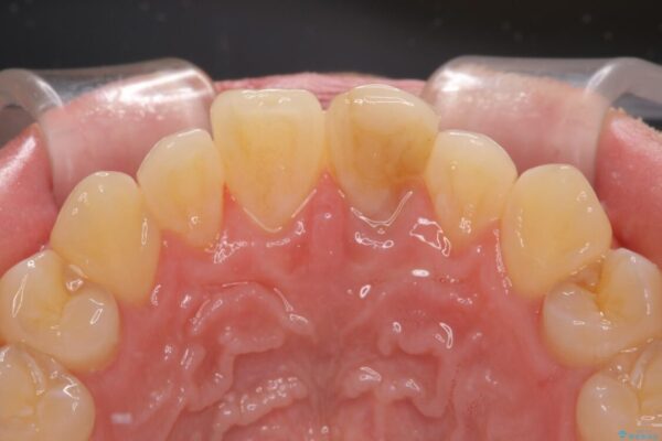 変色した前歯をオールセラミッククラウンに 治療前画像