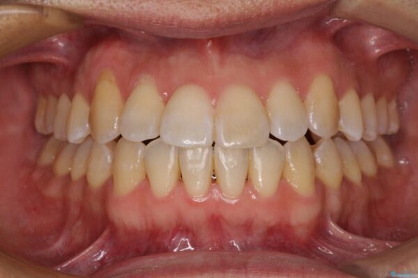 左右の八重歯が気になる　ワイヤー装置での咬み合わせ改善 治療後画像