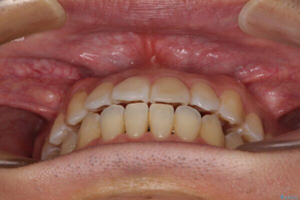 左右の八重歯が気になる　ワイヤー装置での咬み合わせ改善 治療後画像