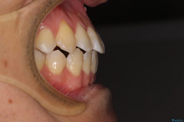 左右の八重歯が気になる　ワイヤー装置での咬み合わせ改善 治療後画像