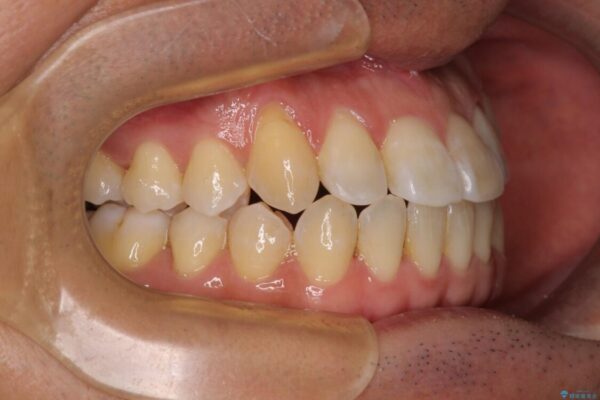 左右の八重歯が気になる　ワイヤー装置での咬み合わせ改善 治療後画像