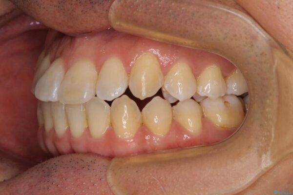 左右の八重歯が気になる　ワイヤー装置での咬み合わせ改善 治療後画像