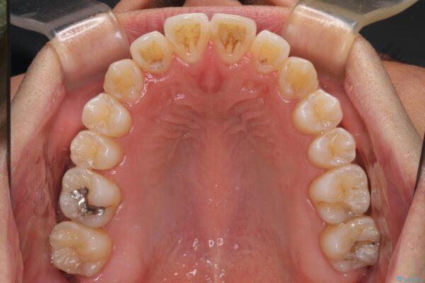 左右の八重歯が気になる　ワイヤー装置での咬み合わせ改善 治療後画像