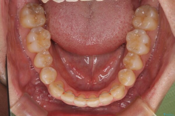 左右の八重歯が気になる　ワイヤー装置での咬み合わせ改善 治療後画像