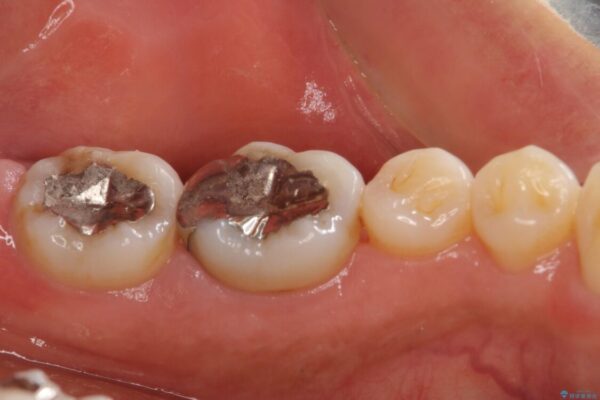 むし歯で歯茎から血が出てくる　オールセラミッククラウンでの補綴治療 治療前画像