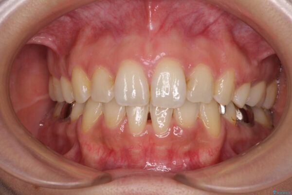 デコボコと口元の突出感　ハーフリンガルでの抜歯矯正 治療後画像