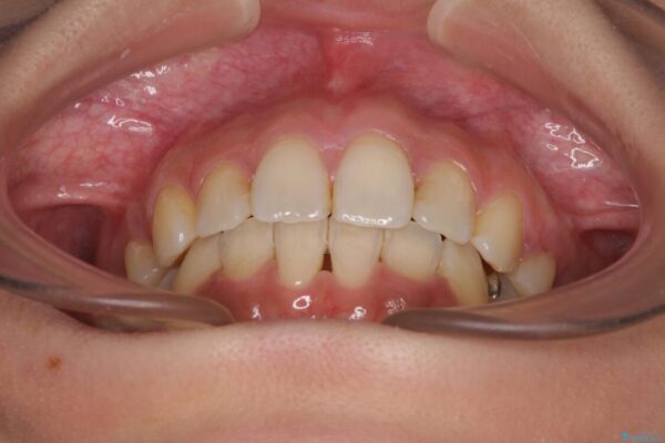 デコボコと口元の突出感　ハーフリンガルでの抜歯矯正 治療後画像