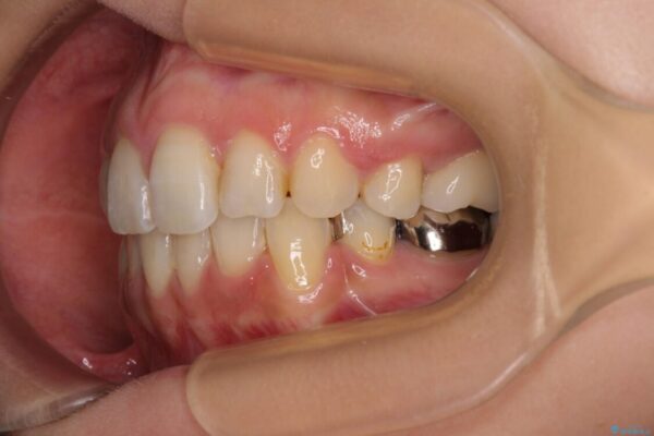 デコボコと口元の突出感　ハーフリンガルでの抜歯矯正 治療後画像