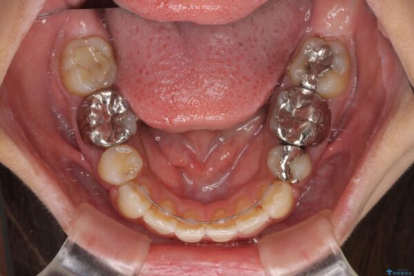 デコボコと口元の突出感　ハーフリンガルでの抜歯矯正 治療後画像