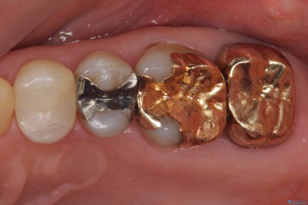 外れてしまった銀歯　セラミックインレーで自然な仕上がりに 治療後画像