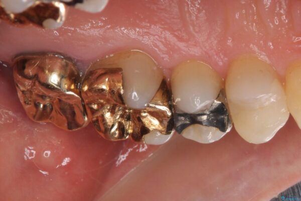 外れてしまった銀歯　セラミックインレーで自然な仕上がりに 治療後画像