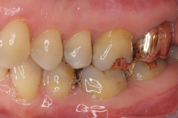 外れてしまった銀歯　セラミックインレーで自然な仕上がりに 治療後画像