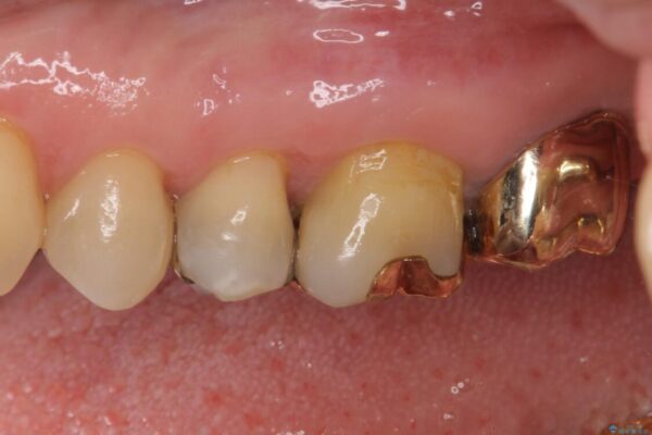 外れてしまった銀歯　セラミックインレーで自然な仕上がりに 治療後画像