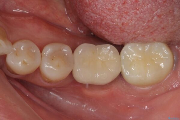 しみる奥歯　オールセラミッククラウンによる補綴治療 アフター
